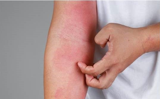 atopiki -dermatitida-therapeia atopiki -dermatitida-therapeia